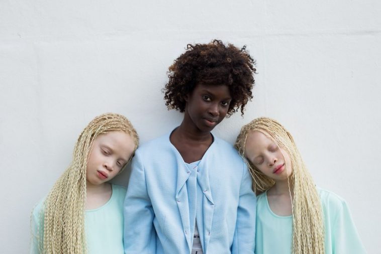 Albino Twins Models From Brazil Stunned The Fashion Industry With Their ...